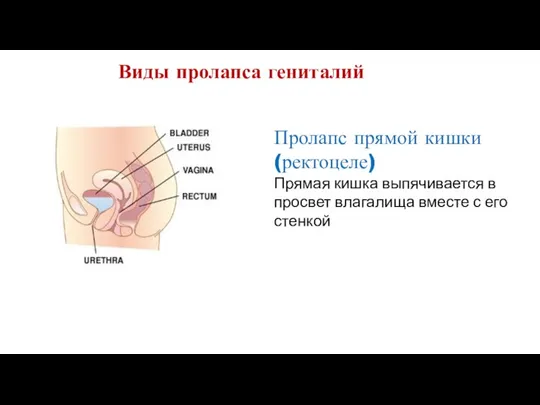 Виды пролапса гениталий Пролапс прямой кишки (ректоцеле) Прямая кишка выпячивается в просвет