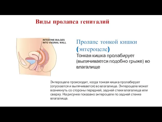 Виды пролапса гениталий Пролапс тонкой кишки (энтероцеле) Тонкая кишка пролабирует (выпячивается подобно