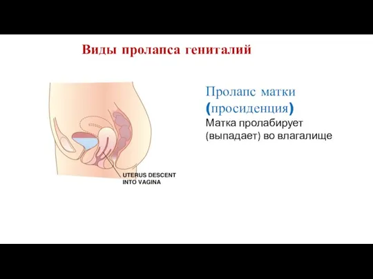 Виды пролапса гениталий Пролапс матки (просиденция) Матка пролабирует (выпадает) во влагалище