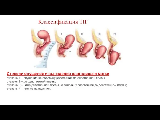 Степени опущения и выпадения влагалища и матки степень 1 – опущение на