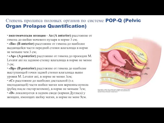 Степень пролапса половых органов по системе POP-Q (Pelvic Organ Prolapse Quantification) ∙