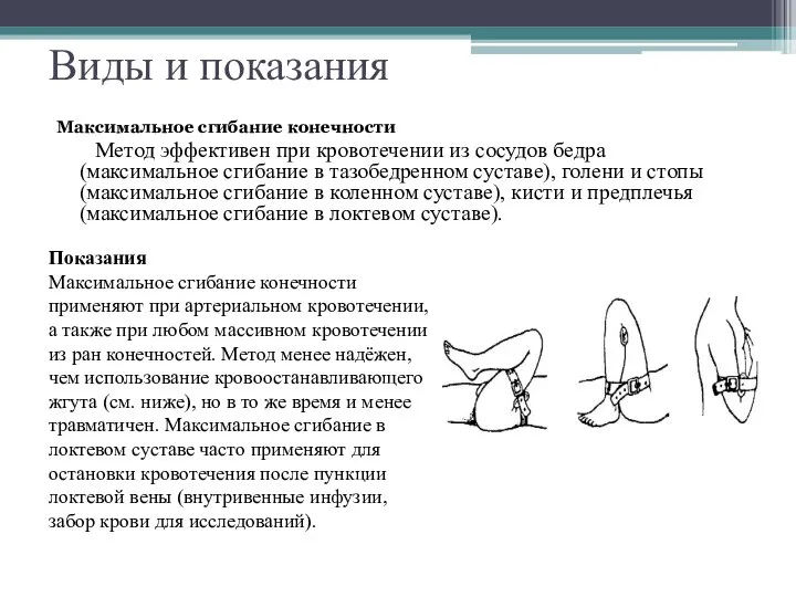 Виды и показания Максимальное сгибание конечности Метод эффективен при кровотечении из сосудов