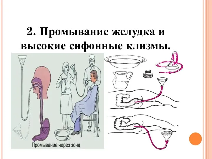 2. Промывание желудка и высокие сифонные клизмы.