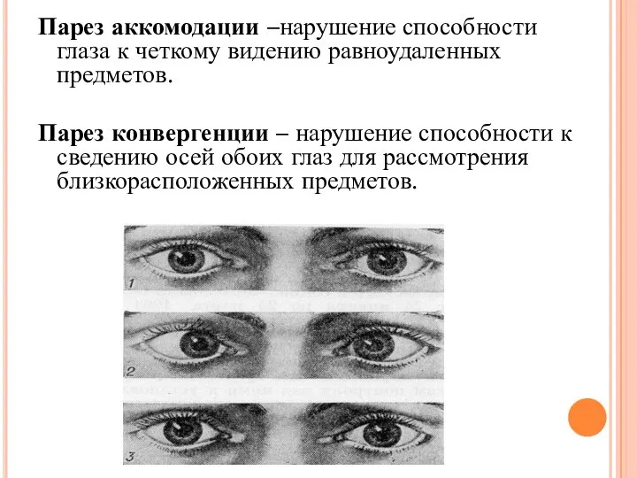 Парез аккомодации –нарушение способности глаза к четкому видению равноудаленных предметов. Парез конвергенции