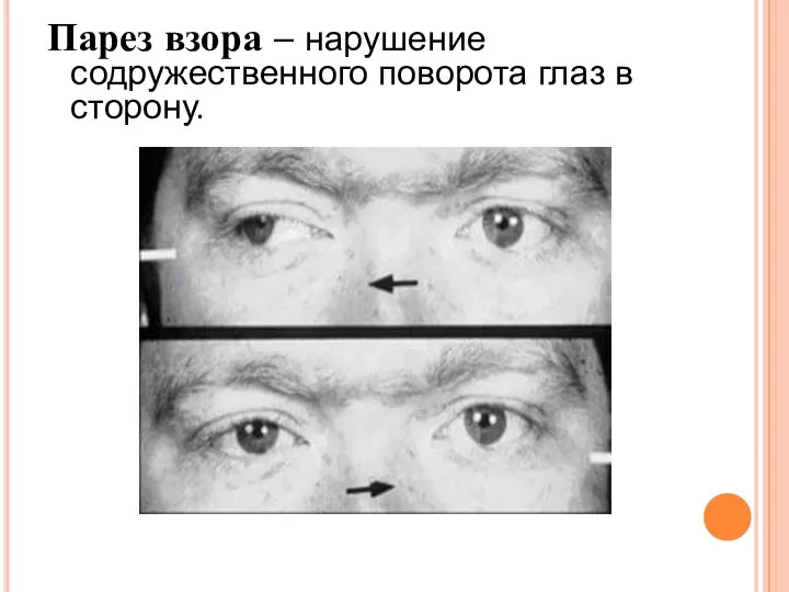 Парез взора – нарушение содружественного поворота глаз в сторону.
