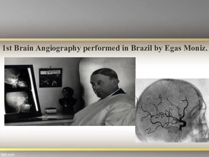 1st Brain Angiography performed in Brazil by Egas Moniz.