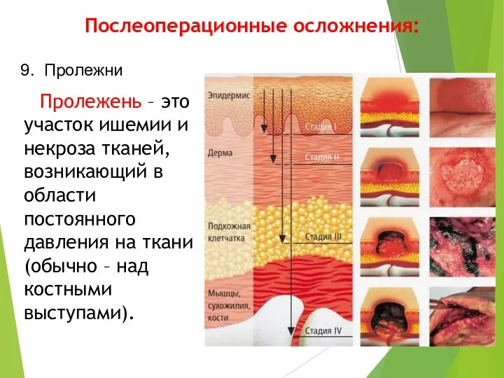 Послеоперационные осложнения: Пролежень – это участок ишемии и некроза тканей, возникающий в