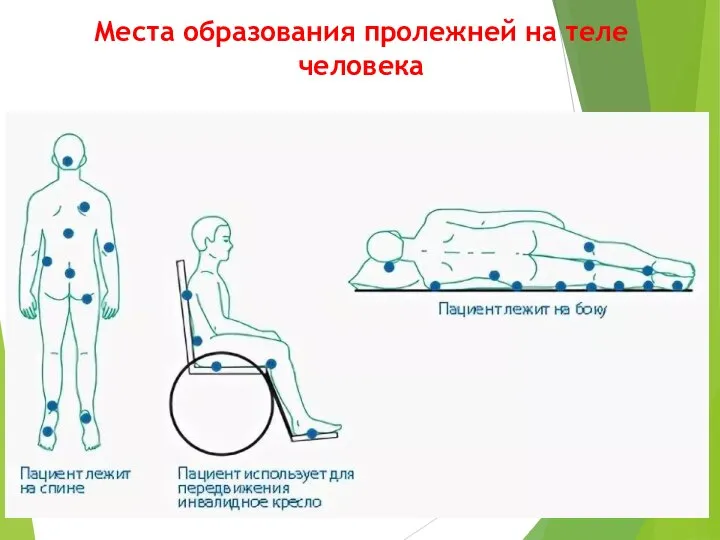 Места образования пролежней на теле человека