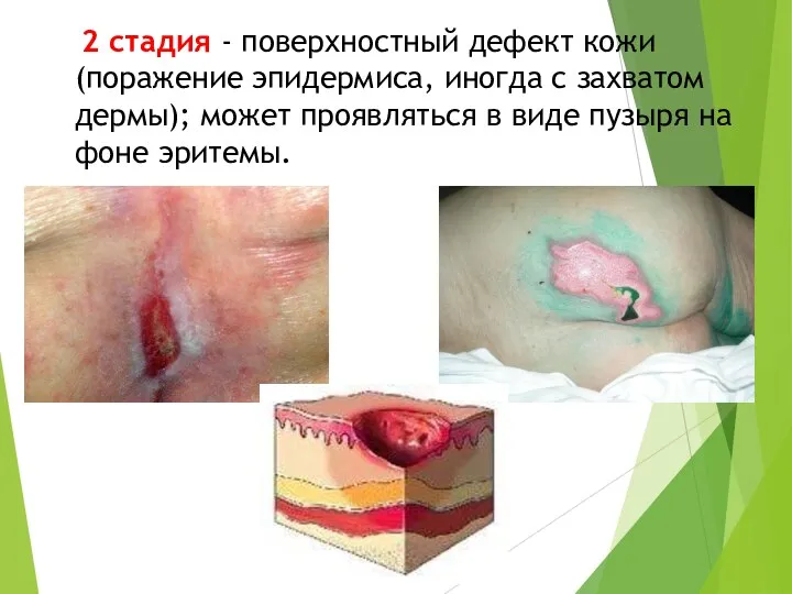 2 стадия - поверхностный дефект кожи (поражение эпидермиса, иногда с захватом дермы);