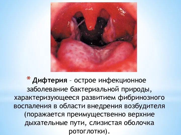 Дифтерия – острое инфекционное заболевание бактериальной природы, характеризующееся развитием фибринозного воспаления в