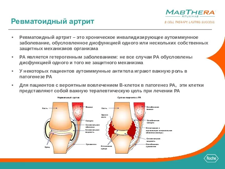 Ревматоидный артрит Ревматоидный артрит – это хроническое инвалидизирующее аутоиммунное заболевание, обусловленное дисфункцией