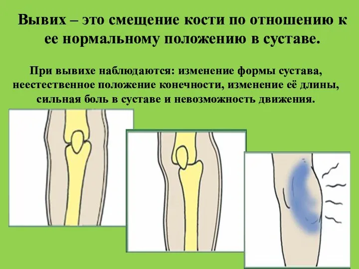 Вывих – это смещение кости по отношению к ее нормальному положению в