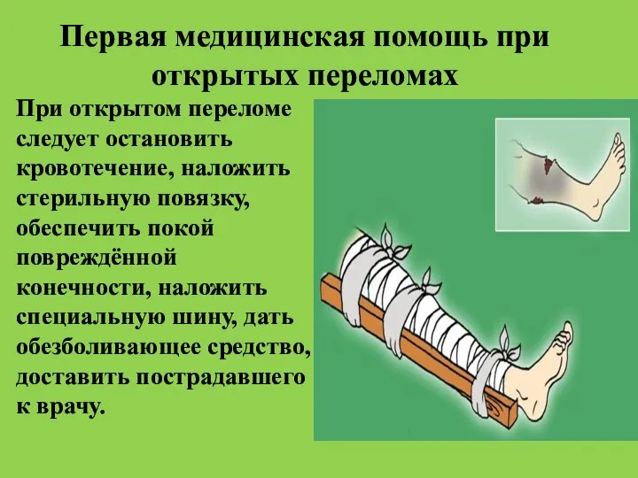 Первая медицинская помощь при открытых переломах При открытом переломе следует остановить кровотечение,