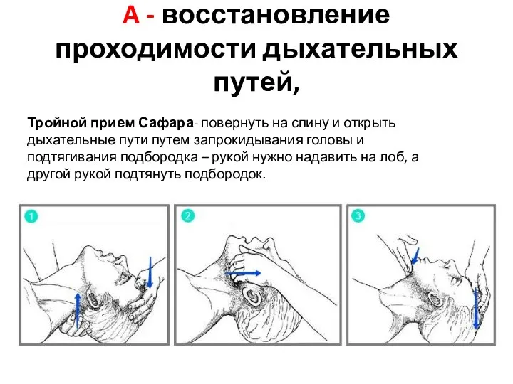 A - восстановление проходимости дыхательных путей, Тройной прием Сафара- повернуть на спину