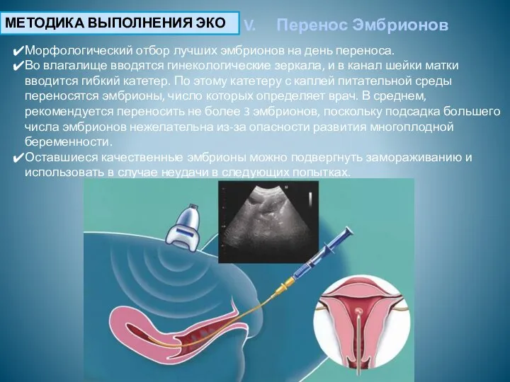 МЕТОДИКА ВЫПОЛНЕНИЯ ЭКО Перенос Эмбрионов Морфологический отбор лучших эмбрионов на день переноса.