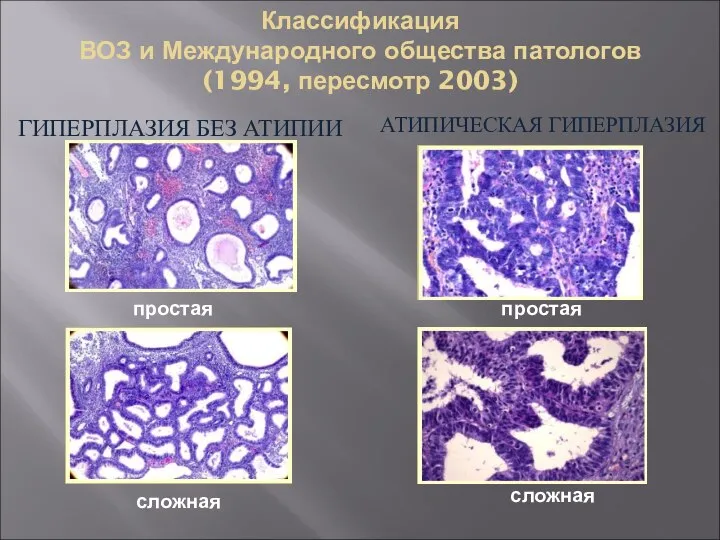 Классификация ВОЗ и Международного общества патологов (1994, пересмотр 2003) ГИПЕРПЛАЗИЯ БЕЗ АТИПИИ