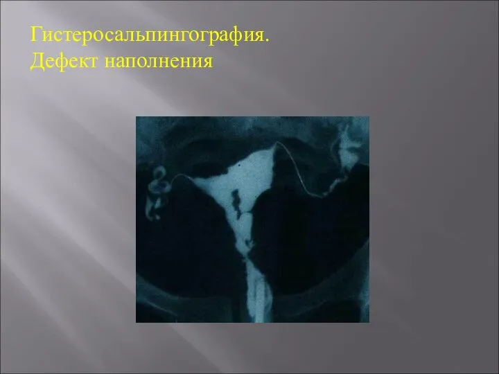 Гистеросальпингография. Дефект наполнения