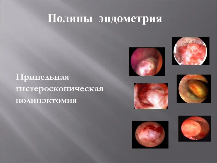 Полипы эндометрия Прицельная гистероскопическая полипэктомия