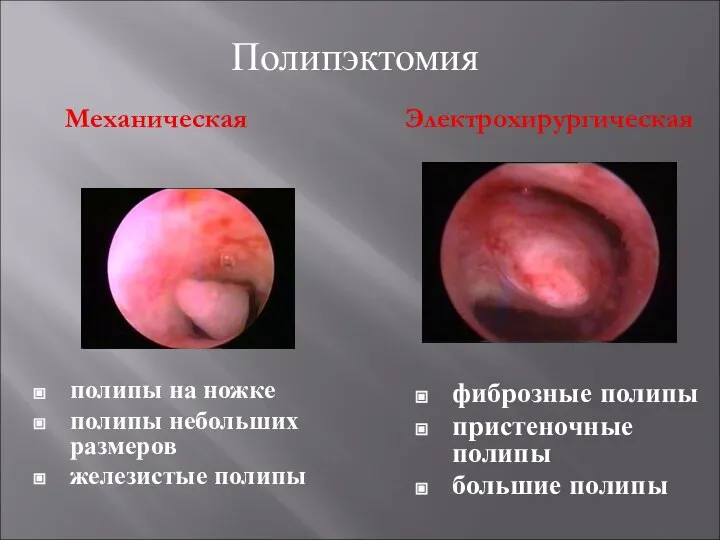 полипы на ножке полипы небольших размеров железистые полипы фиброзные полипы пристеночные полипы