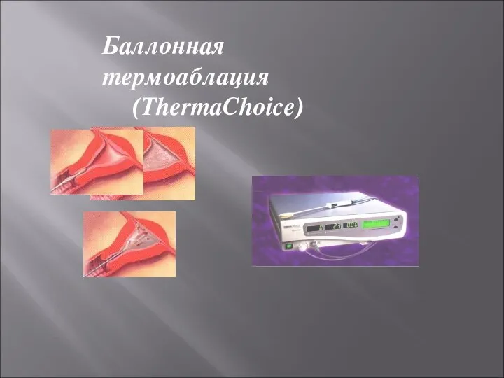 Баллонная термоаблация (ThermaChoice)