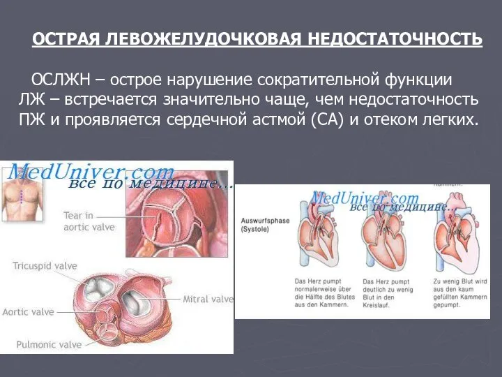 ОСТРАЯ ЛЕВОЖЕЛУДОЧКОВАЯ НЕДОСТАТОЧНОСТЬ ОСЛЖН – острое нарушение сократительной функции ЛЖ – встречается