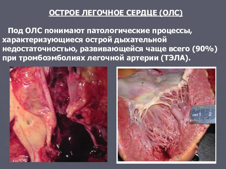 ОСТРОЕ ЛЕГОЧНОЕ СЕРДЦЕ (ОЛС) Под ОЛС понимают патологические процессы, характеризующиеся острой дыхательной