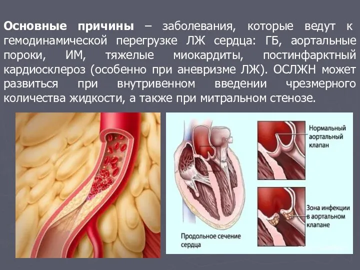 Основные причины – заболевания, которые ведут к гемодинамической перегрузке ЛЖ сердца: ГБ,