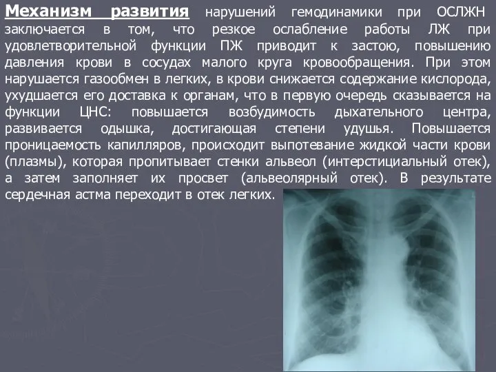 Механизм развития нарушений гемодинамики при ОСЛЖН заключается в том, что резкое ослабление