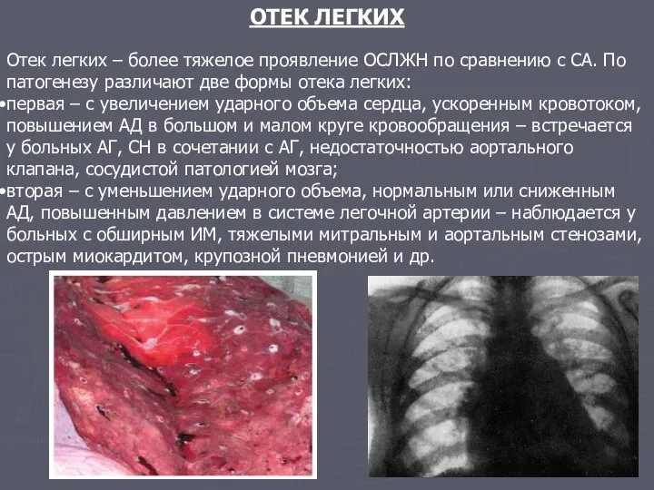 ОТЕК ЛЕГКИХ Отек легких – более тяжелое проявление ОСЛЖН по сравнению с