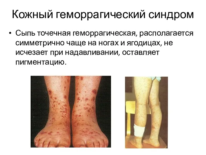 Кожный геморрагический синдром Сыпь точечная геморрагическая, располагается симметрично чаще на ногах и