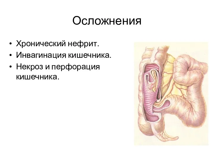 Осложнения Хронический нефрит. Инвагинация кишечника. Некроз и перфорация кишечника.