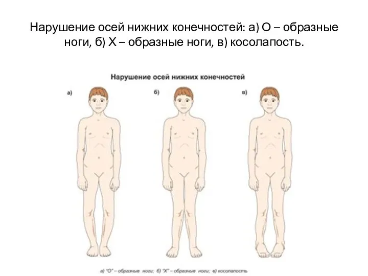 Нарушение осей нижних конечностей: а) О – образные ноги, б) Х – образные ноги, в) косолапость.