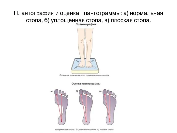 Плантография и оценка плантограммы: а) нормальная стопа, б) уплощенная стопа, в) плоская стопа.