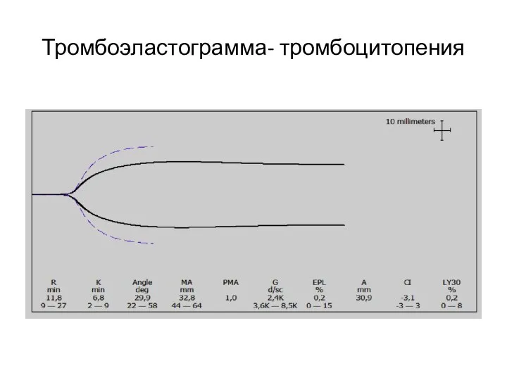 Тромбоэластограмма- тромбоцитопения