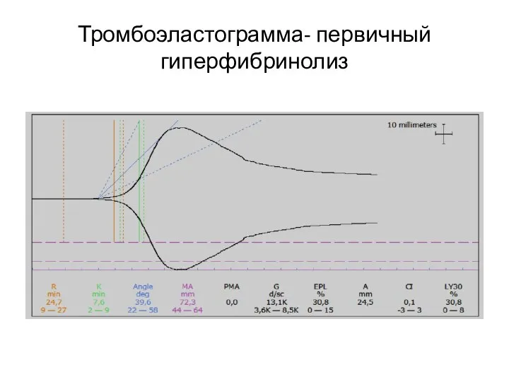 Тромбоэластограмма- первичный гиперфибринолиз