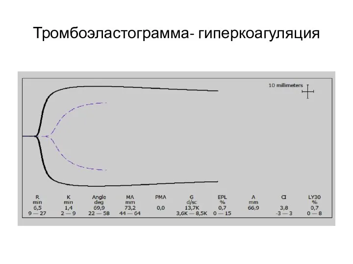 Тромбоэластограмма- гиперкоагуляция