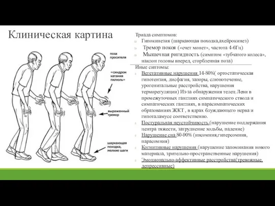 Клиническая картина Триада симптомов: Гипокинезия (шаркающая походка,ахейрокинез) Тремор покоя («счет монет», частота