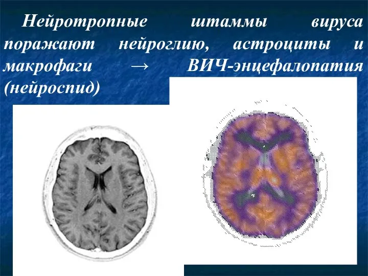 Нейротропные штаммы вируса поражают нейроглию, астроциты и макрофаги → ВИЧ-энцефалопатия (нейроспид)