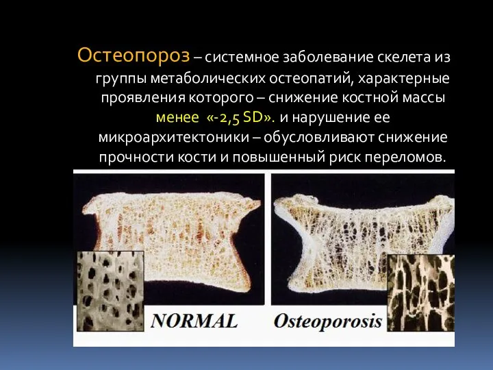 Остеопороз – системное заболевание скелета из группы метаболических остеопатий, характерные проявления которого