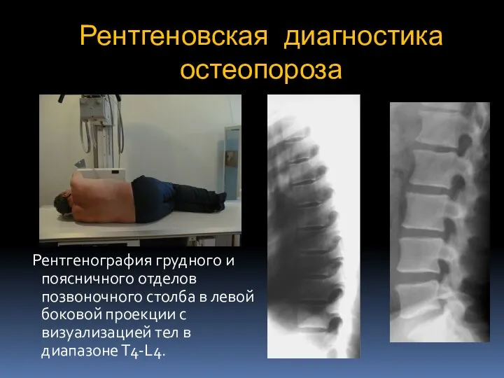 Рентгеновская диагностика остеопороза Рентгенография грудного и поясничного отделов позвоночного столба в левой
