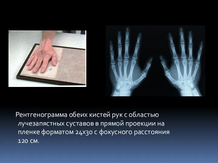 Рентгенограмма обеих кистей рук с областью лучезапястных суставов в прямой проекции на
