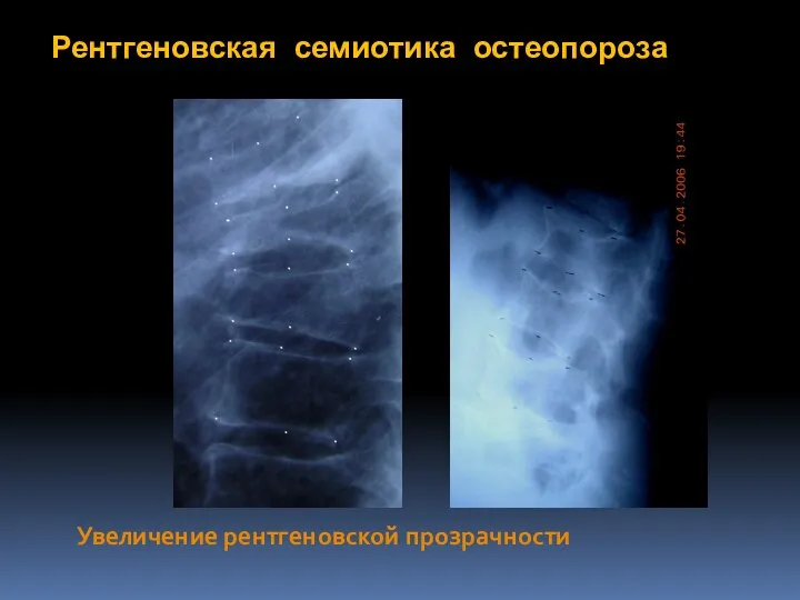 Рентгеновская семиотика остеопороза Увеличение рентгеновской прозрачности