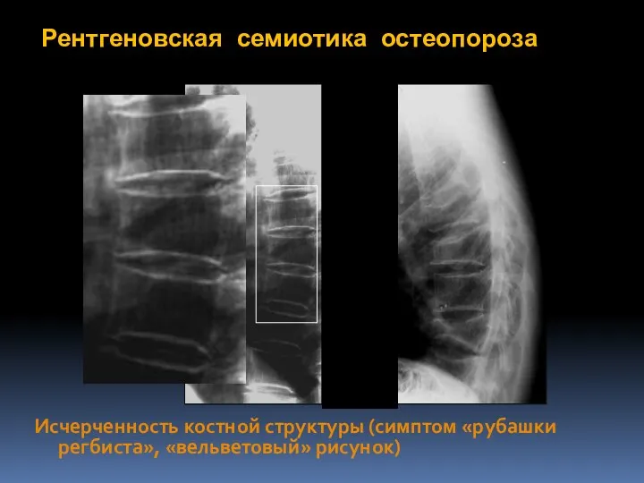 Рентгеновская семиотика остеопороза Исчерченность костной структуры (симптом «рубашки регбиста», «вельветовый» рисунок)