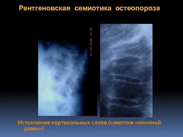 Рентгеновская семиотика остеопороза Истончение кортикальных слоев (симптом «оконной рамы»)