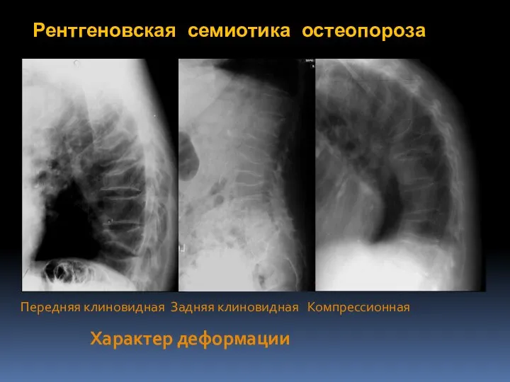 Характер деформации Рентгеновская семиотика остеопороза Передняя клиновидная Задняя клиновидная Компрессионная