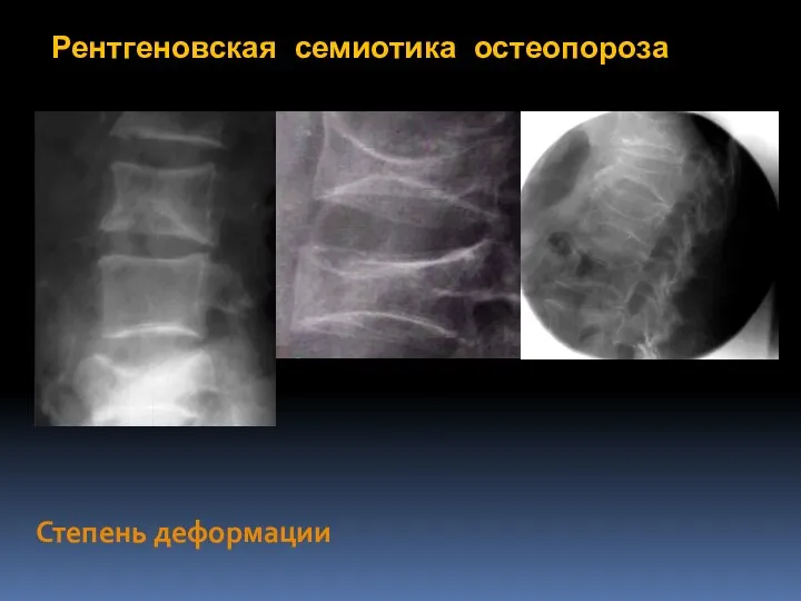 Рентгеновская семиотика остеопороза Степень деформации