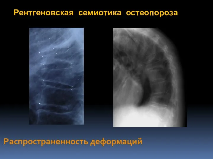 Рентгеновская семиотика остеопороза Распространенность деформаций