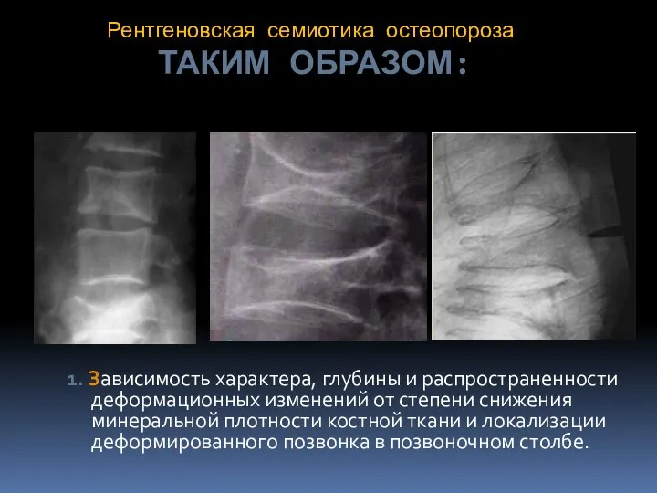 Рентгеновская семиотика остеопороза ТАКИМ ОБРАЗОМ: 1. Зависимость характера, глубины и распространенности деформационных