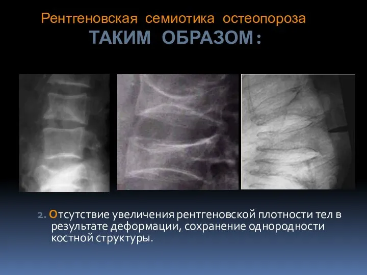Рентгеновская семиотика остеопороза ТАКИМ ОБРАЗОМ: 2. Отсутствие увеличения рентгеновской плотности тел в