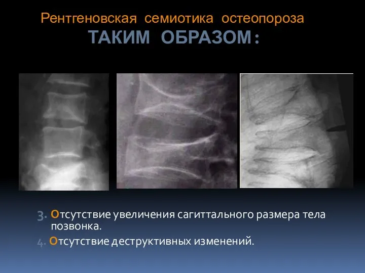 Рентгеновская семиотика остеопороза ТАКИМ ОБРАЗОМ: 3. Отсутствие увеличения сагиттального размера тела позвонка. 4. Отсутствие деструктивных изменений.